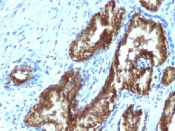 TDP2 / TTRAP Antibody - IHC testing of FFPE human prostate carcinoma with TDP2 antibody (clone TDP2/1258). Required HIER: boil tissue sections in 10mM Tris with 1mM EDTA, pH 9, for 10-20 min followed by cooling at RT for 20 min.