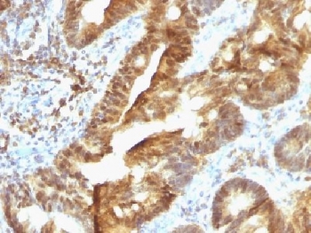 TDP2 / TTRAP Antibody - IHC testing of FFPE human colon carcinoma with TDP2 antibody (clone TDP2/1258). Required HIER: boil tissue sections in 10mM Tris with 1mM EDTA, pH 9, for 10-20 min followed by cooling at RT for 20 min.