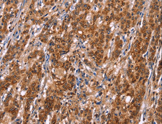 TDP2 / TTRAP Antibody - Immunohistochemistry of paraffin-embedded Human thyroid cancer using TDP2 Polyclonal Antibody at dilution of 1:40.