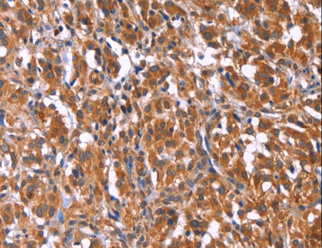 TDP2 / TTRAP Antibody - Immunohistochemistry of paraffin-embedded Human thyroid cancer using TDP2 Polyclonal Antibody at dilution of 1:40.