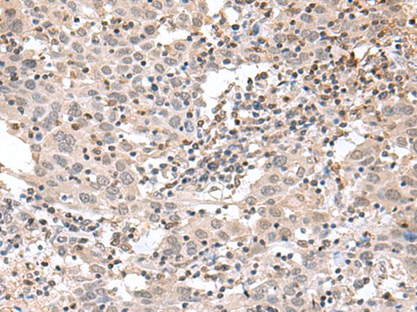 TDP2 / TTRAP Antibody - Immunohistochemistry of paraffin-embedded Human cervical cancer tissue  using TDP2 Polyclonal Antibody at dilution of 1:75(×200)