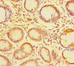 TDRD1 Antibody - Immunohistochemistry of paraffin-embedded human gastric cancer at dilution of 1:100
