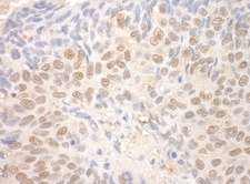 TDRD3 Antibody - Detection of Human TDRD3 by Immunohistochemistry. Sample: FFPE section of human lung carcinoma. Antibody: Affinity purified rabbit anti-TDRD3 used at a dilution of 1:250.