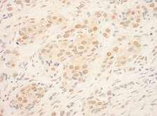 TDRD3 Antibody - Detection of Human TDRD3 by Immunohistochemistry. Sample: FFPE section of human breast carcinoma. Antibody: Affinity purified rabbit anti-TDRD3 used at a dilution of 1:1000 (1 ug/ml). Detection: DAB.