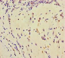 TDRD3 Antibody - Immunohistochemistry of paraffin-embedded human lung cancer at dilution of 1:100