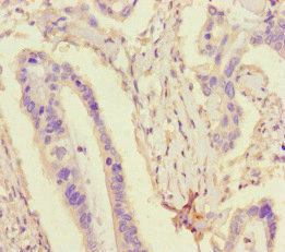 TDRD3 Antibody - Immunohistochemistry of paraffin-embedded human pancreatic cancer at dilution of 1:100