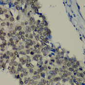 TEAD1 Antibody - Immunohistochemistry of paraffin-embedded human lung cancer tissue.