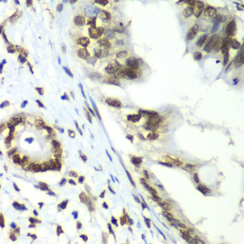 TEAD1 Antibody - Immunohistochemistry of paraffin-embedded human liver cancer tissue.