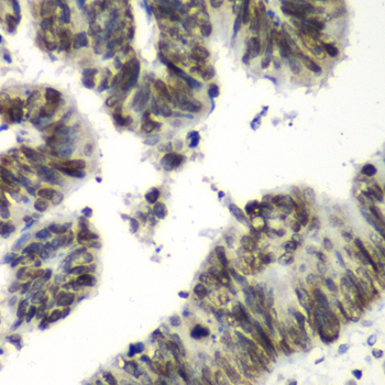 TEAD1 Antibody - Immunohistochemistry of paraffin-embedded human colon carcinoma tissue.