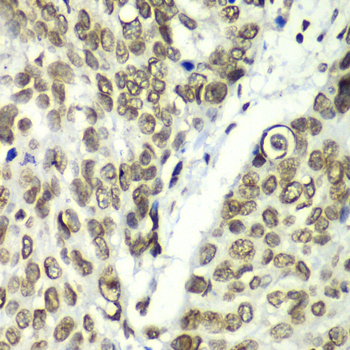 TEAD1 Antibody - Immunohistochemistry of paraffin-embedded human esophageal cancer tissue.