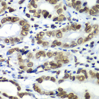 TEAD1 Antibody - Immunohistochemistry of paraffin-embedded human gastric cancer tissue.