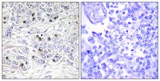 TEAD2 Antibody - Immunohistochemistry analysis of paraffin-embedded human breast carcinoma tissue, using TEAD2 Antibody. The picture on the right is blocked with the synthesized peptide.