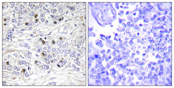 TEAD2 Antibody - Peptide - + Immunohistochemistry analysis of paraffin-embedded human breast carcinoma tissue, using TEAD2 antibody.