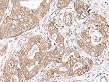 TEAD2 Antibody - Immunohistochemistry of paraffin-embedded Human gastric cancer tissue  using TEAD2 Polyclonal Antibody at dilution of 1:60(×200)