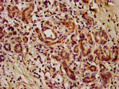 TEAD3 Antibody - IHC image of TEAD3 Antibody diluted at 1:1000 and staining in paraffin-embedded human pancreatic cancer performed on a Leica BondTM system. After dewaxing and hydration, antigen retrieval was mediated by high pressure in a citrate buffer (pH 6.0). Section was blocked with 10% normal goat serum 30min at RT. Then primary antibody (1% BSA) was incubated at 4°C overnight. The primary is detected by a biotinylated secondary antibody and visualized using an HRP conjugated SP system.