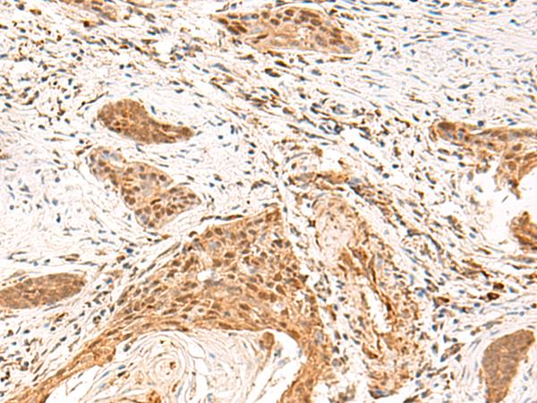 TEAD3 Antibody - Immunohistochemistry of paraffin-embedded Human esophagus cancer tissue  using TEAD3 Polyclonal Antibody at dilution of 1:50(×200)