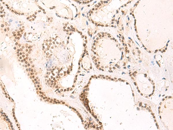 TEAD3 Antibody - Immunohistochemistry of paraffin-embedded Human thyroid cancer tissue  using TEAD3 Polyclonal Antibody at dilution of 1:50(×200)