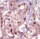 TEC Antibody - Formalin-fixed and paraffin-embedded human cancer tissue reacted with the primary antibody, which was peroxidase-conjugated to the secondary antibody, followed by AEC staining. This data demonstrates the use of this antibody for immunohistochemistry; clinical relevance has not been evaluated. BC = breast carcinoma; HC = hepatocarcinoma.