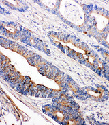 TEC Antibody - TEC antibody. IHC(P): Human Intestinal Cancer Tissue.