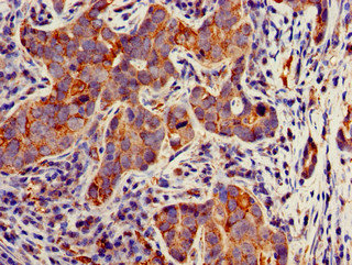 TECPR2 Antibody - Immunohistochemistry of paraffin-embedded human pancreatic cancer using TECPR2 Antibody at dilution of 1:100