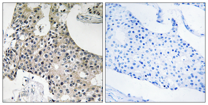 TECR / TER Antibody - Immunohistochemistry analysis of paraffin-embedded human breast carcinoma tissue, using GPSN2 Antibody. The picture on the right is blocked with the synthesized peptide.