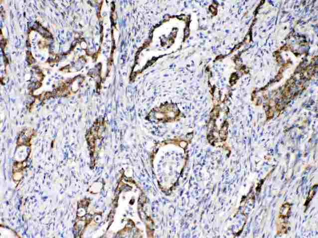 TECTA Antibody - TECTA was detected in paraffin-embedded sections of human intetsinal cancer tissues using rabbit anti- TECTA Antigen Affinity purified polyclonal antibody