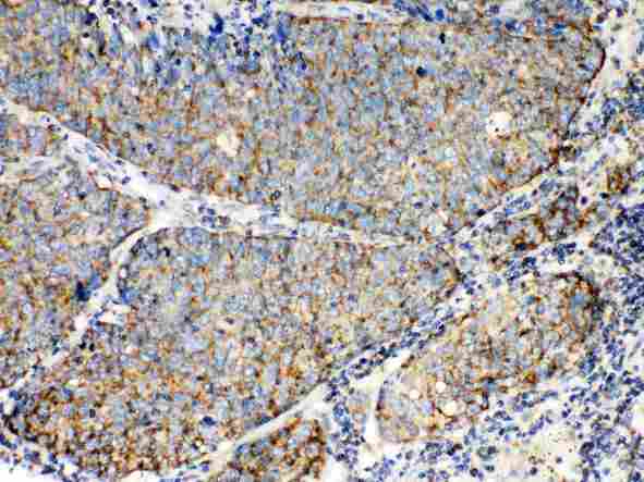 TECTA Antibody - TECTA was detected in paraffin-embedded sections of human lung cancer tissues using rabbit anti- TECTA Antigen Affinity purified polyclonal antibody