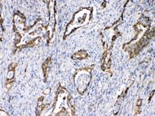 TECTA Antibody - IHC testing of FFPE human intestinal cancer tissue with TECTA antibody at 1ug/ml. Required HIER: steam section in pH6 citrate buffer for 20 min and allow to cool prior to testing.