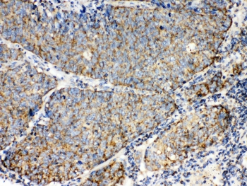 TECTA Antibody - IHC testing of FFPE human lung cancer tissue with TECTA antibody at 1ug/ml. Required HIER: steam section in pH6 citrate buffer for 20 min and allow to cool prior to testing.
