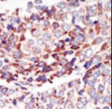 TEK / TIE2 Antibody - Formalin-fixed and paraffin-embedded human cancer tissue reacted with the primary antibody, which was peroxidase-conjugated to the secondary antibody, followed by AEC staining. This data demonstrates the use of this antibody for immunohistochemistry; clinical relevance has not been evaluated. BC = breast carcinoma; HC = hepatocarcinoma.
