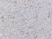 TEK / TIE2 Antibody - IHC staining of FFPE human breast cancer with TEK antibody at 1ug/ml. HIER: boil tissue sections in pH6, 10mM citrate buffer, for 10-20 min and allow to cool before testing.