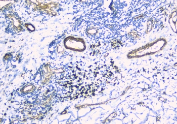 TEK / TIE2 Antibody - IHC staining of FFPE human lung cancer with TEK antibody at 1ug/ml. HIER: boil tissue sections in pH6, 10mM citrate buffer, for 10-20 min and allow to cool before testing.