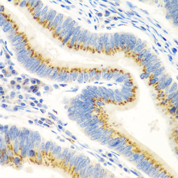 TERE1 / UBIAD1 Antibody - Immunohistochemistry of paraffin-embedded human colon carcinoma tissue.