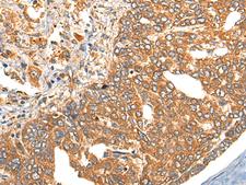 TERE1 / UBIAD1 Antibody - Immunohistochemistry of paraffin-embedded Human liver cancer tissue  using UBIAD1 Polyclonal Antibody at dilution of 1:40(×200)