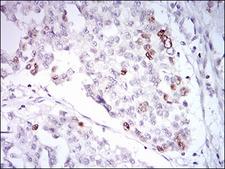 TERF2 / TRF2 Antibody - IHC of paraffin-embedded ovarian cancer tissues using TERF2 mouse monoclonal antibody with DAB staining.