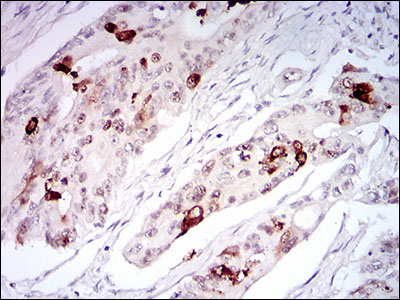 TERF2 / TRF2 Antibody - IHC of paraffin-embedded rectum cancer tissues using TERF2 mouse monoclonal antibody with DAB staining.