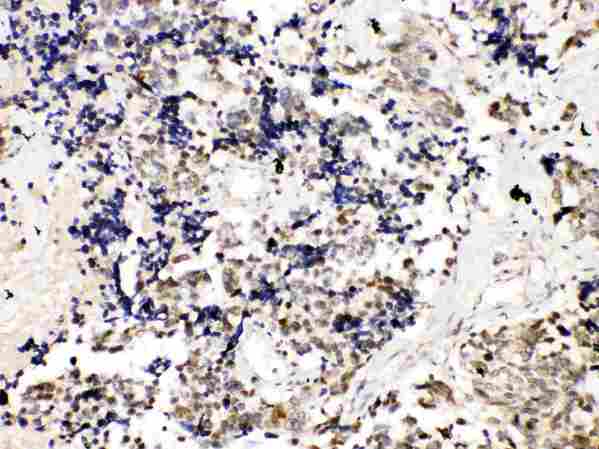 TERF2 / TRF2 Antibody - TRF2 was detected in paraffin-embedded sections of human lung cancer tissues using rabbit anti- TRF2 Antigen Affinity purified polyclonal antibody