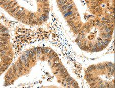 TERF2 / TRF2 Antibody - Immunohistochemistry of paraffin-embedded Human colon cancer using TERF2 Polyclonal Antibody at dilution of 1:50.