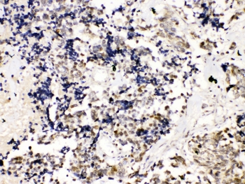 TERF2 / TRF2 Antibody - IHC testing of FFPE human lung cancer tissue with TRF2 antibody at 1ug/ml. Required HIER: steam section in pH6 citrate buffer for 20 min and allow to cool prior to testing.