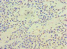 TERF2IP / RAP1 Antibody - Immunohistochemistry of paraffin-embedded human breast cancer using antibody at 1:100 dilution.