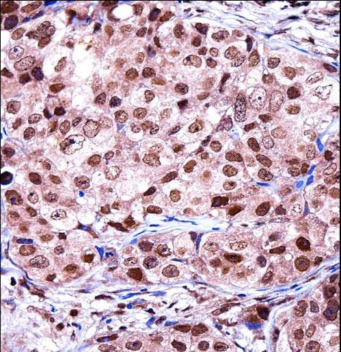 TERF2IP / RAP1 Antibody - TERF2IP Antibody immunohistochemistry of formalin-fixed and paraffin-embedded human breast carcinoma followed by peroxidase-conjugated secondary antibody and DAB staining.