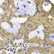 TERF2IP / RAP1 Antibody - Immunohistochemistry of paraffin-embedded human oophoroma tissue.