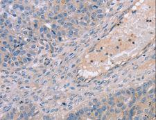 TERT / Telomerase Antibody - Immunohistochemistry of paraffin-embedded Human breast cancer using TERT Polyclonal Antibody at dilution of 1:35.