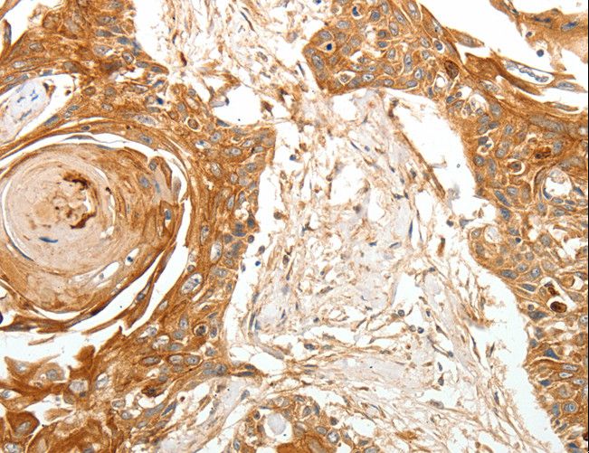 TERT / Telomerase Antibody - Immunohistochemistry of paraffin-embedded Human esophagus cancer using TERT Polyclonal Antibody at dilution of 1:40.