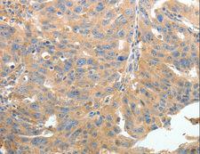 TERT / Telomerase Antibody - Immunohistochemistry of paraffin-embedded Human thyroid cancer using TERT Polyclonal Antibody at dilution of 1:50.