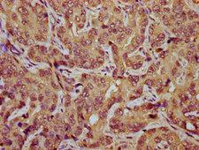 TES / Testin Antibody - Immunohistochemistry Dilution at 1:800 and staining in paraffin-embedded human liver cancer performed on a Leica BondTM system. After dewaxing and hydration, antigen retrieval was mediated by high pressure in a citrate buffer (pH 6.0). Section was blocked with 10% normal Goat serum 30min at RT. Then primary antibody (1% BSA) was incubated at 4°C overnight. The primary is detected by a biotinylated Secondary antibody and visualized using an HRP conjugated SP system.