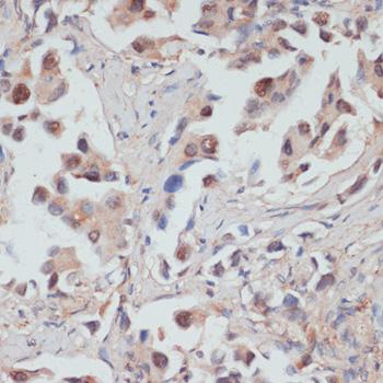 TES / Testin Antibody - Immunohistochemistry of paraffin-embedded Human lung cancer using TES Polyclonal Antibody at dilution of 1:100 (40x lens).