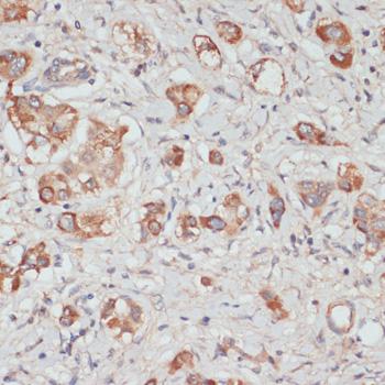 TES / Testin Antibody - Immunohistochemistry of paraffin-embedded Human liver cancer using TES Polyclonal Antibody at dilution of 1:100 (40x lens).
