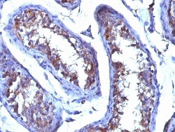 Testosterone Antibody - Formalin-fixed. Paraffin-embedded human testicular carcinoma stained with Testosterone antibody (4E1G2) This image was taken for the unmodified form of this product. Other forms have not been tested.