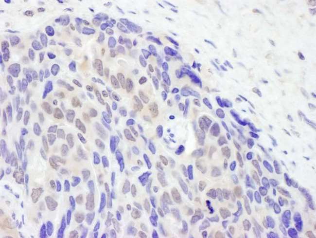TET2 Antibody - Detection of Human TET2 by Immunohistochemistry. Sample: FFPE section of human ovarian carcinoma. Antibody: Affinity purified rabbit anti-TET2 used at a dilution of 1:5000 (0.2 Detection: DAB.